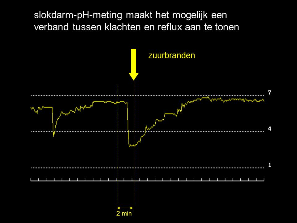 Slokdarm pH meting en refluxklachten