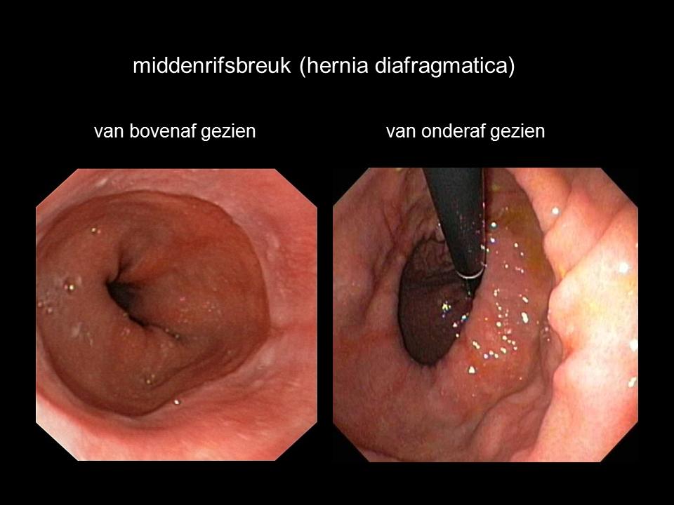 hernia diafragmatica